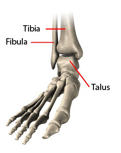 achilles tendonitis