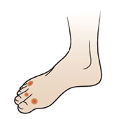 callous and corns