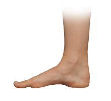 fallen arches over-pronation