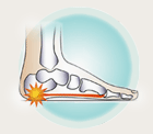 Heel Pain